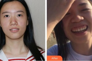 黃石現(xiàn)代口腔醫(yī)院夏風整形價格表附金屬托槽矯正案例展示