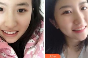 黃石春天口腔門診部劉春林整形價格表附牙齒隱形矯正案例展示