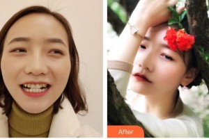 黃石中山口腔醫(yī)院楊勇軍整形價(jià)格表附牙齒隱形矯正案例展示