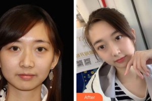 十堰陽光整形醫(yī)院黃金井整形價格表附熱瑪吉案例展示