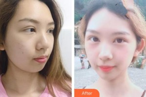 十堰阿芙羅醫(yī)療整形美容門診部林平珍整形價格表附埋線提升案例展示