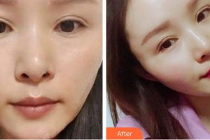 十堰陽光整形醫(yī)院侯澤民整形價格表附熱拉提案例展示