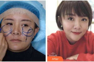 十堰東慧醫(yī)療美容門診部曾祥蘭整形價格表附埋線提升案例展示