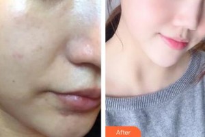 十堰太和醫(yī)院整形美容中心何明武整形價格表附埋線提升案例展示