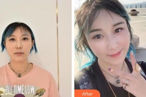 十堰東慧醫(yī)療美容門診部余建軍整形價格表附埋線提升案例展示