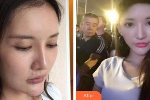 十堰陽光整形醫(yī)院李明整形價格表附埋線提升案例展示