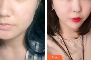 十堰陽光整形醫(yī)院楊峰整形價格表附埋線提升案例展示