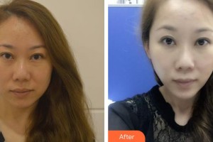 十堰市人民醫(yī)院整形美容燒傷外科陸華整形價格表附埋線提升案例展示