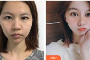 十堰愛爾眼科醫(yī)院張青松整形價格表附熱拉提案例展示