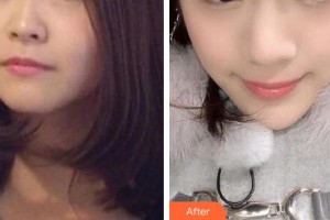 十堰市人民醫(yī)院整形美容燒傷外科王鵬整形價格表附熱拉提案例展示