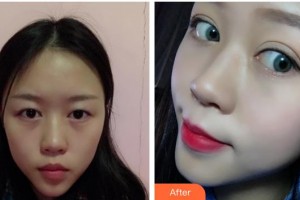 十堰安琪兒醫(yī)學美容門診部鄒來興整形價格表附眼部綜合案例展示