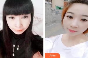 十堰愛爾眼科醫(yī)院李凌整形價格表附切眉術案例展示