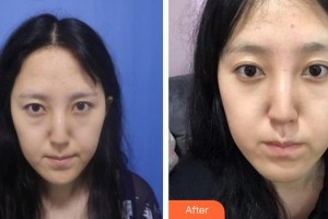 十堰愛爾眼科醫(yī)院楊永清整形價格表附激光去眼袋案例展示