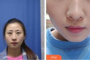 十堰愛爾眼科醫(yī)院李儒華整形價格表附切開雙眼皮案例展示