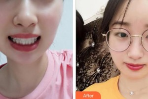 十堰東風口腔醫(yī)院梁學進整形價格表附美白貼片案例展示