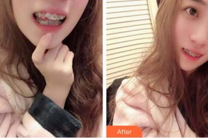 十堰東風口腔醫(yī)院李守宏整形價格表附金屬托槽矯正案例展示