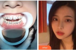 十堰東風口腔醫(yī)院董紅整形價格表附隱形托槽矯正案例展示