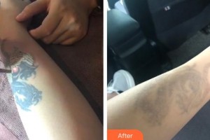 襄陽市中心醫(yī)院整形美容科胡強(qiáng)整形價格表附激光去紋身案例展示