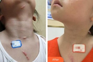 襄陽市中心醫(yī)院整形美容科王琦整形價(jià)格表附激光祛疤案例展示