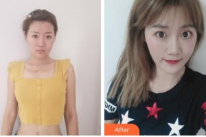 襄陽海峽醫(yī)療美容門診部吳新建整形價(jià)格表附激光祛疤案例展示