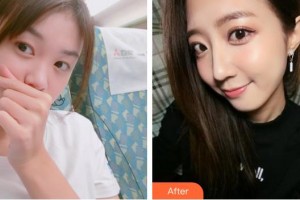 襄陽海峽醫(yī)療美容門診部郭永軍整形價(jià)格表附鼻部綜合案例展示