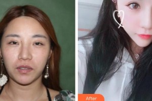 襄陽德爾美客西子醫(yī)療整形美容門診部趙裴整形價(jià)格表附鼻部綜合案例展示