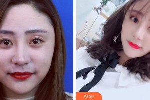 襄陽維多利亞醫(yī)療美容醫(yī)院曹仁昌整形價(jià)格表附鼻部綜合案例展示