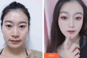 襄陽伊萊美醫(yī)療美容醫(yī)院鄭東學(xué)整形價格表附鼻部綜合案例展示