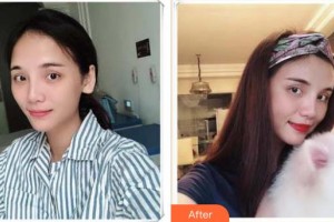 襄陽韓蔻醫(yī)療美容門診部金慶淑整形價格表附自體脂肪填充蘋果肌案例展示