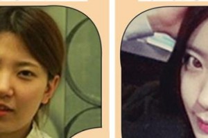 襄陽韓美醫(yī)療美容醫(yī)院段娟整形價格表附自體脂肪填充蘋果肌案例展示