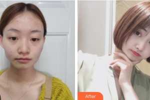 襄陽伯蒂醫(yī)療美容門診部葉武鋒整形價格表附自體脂肪全臉填充案例展示