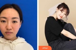 襄陽韓蔻醫(yī)療美容門診部王健強(qiáng)整形價格表附熱瑪吉案例展示