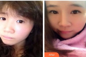 襄陽愛爾眼科醫(yī)院邱志方整形價格表附切開雙眼皮案例展示