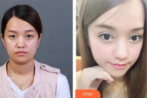 襄陽愛爾眼科醫(yī)院龔麟整形價格表附切開雙眼皮案例展示