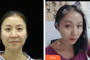 襄陽愛爾眼科醫(yī)院朱琴整形價格表附眼部修復(fù)案例展示