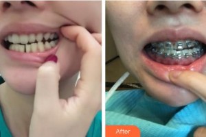 襄陽佳潔口腔醫(yī)院胡毅整形價格表附金屬托槽矯正案例展示