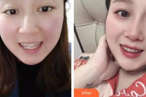 襄陽市口腔醫(yī)院陳昕整形價格表附牙齒隱形矯正案例展示