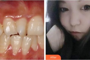 襄陽牙牙口腔門診部王林虎整形價格表附牙齒隱形矯正案例展示