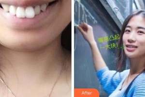 襄陽時代口腔醫(yī)院呂吳紀整形價格表附金屬托槽矯正案例展示