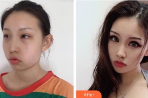 襄陽市第一人民醫(yī)院劉羽整形價格表附熱瑪吉案例展示