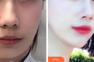 襄陽市第一人民醫(yī)院潘穎喆整形價格表附埋線提升案例展示