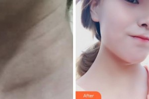 襄陽市第一人民醫(yī)院周新春整形價格表附嗨體去頸紋案例展示