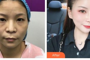 恩施中韓整形美容醫(yī)院陳海良整形價格表附肋軟骨隆鼻案例展示