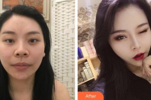 恩施華美整形美容門診部埃倫整形價格表附肋軟骨隆鼻案例展示