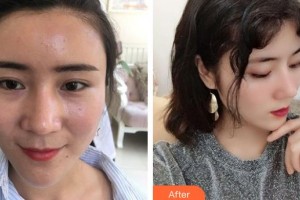 恩施華美整形美容門診部徐懷河整形價格表附鼻部綜合案例展示