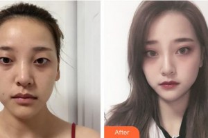 恩施慧益眼科醫(yī)院包煜芝整形價格表附眼部綜合案例展示