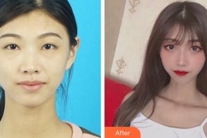 恩施慧益眼科醫(yī)院周瑜整形價格表附內切祛眼袋案例展示