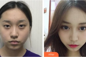 恩施慧益眼科醫(yī)院李新宇整形價格表附眼部綜合案例展示