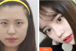 恩施慧益眼科醫(yī)院賀濤整形價格表附埋線雙眼皮案例展示