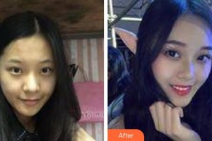 仙桃友好醫(yī)學美容醫(yī)院吳小蔚整形價格表附膠原蛋白除皺案例展示